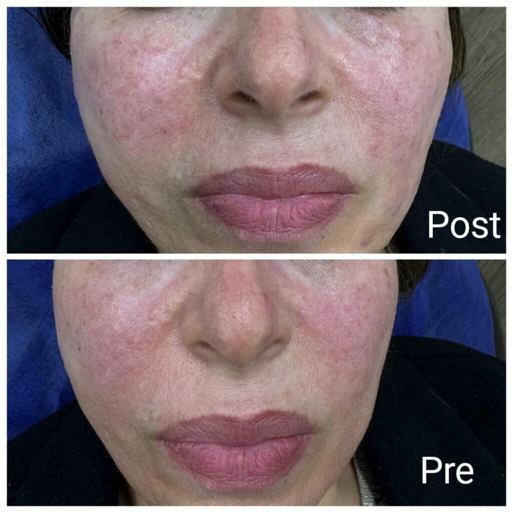Skin improvement after a Skin Booster session
